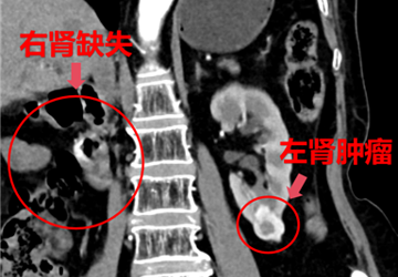 突破极限！蚌埠市中心医院成功应对孤立肾多发肿瘤手术挑战