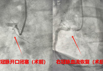 生死时速|   10分钟！蚌埠市中心医院心血管内科极速救治急性心梗患者(2)